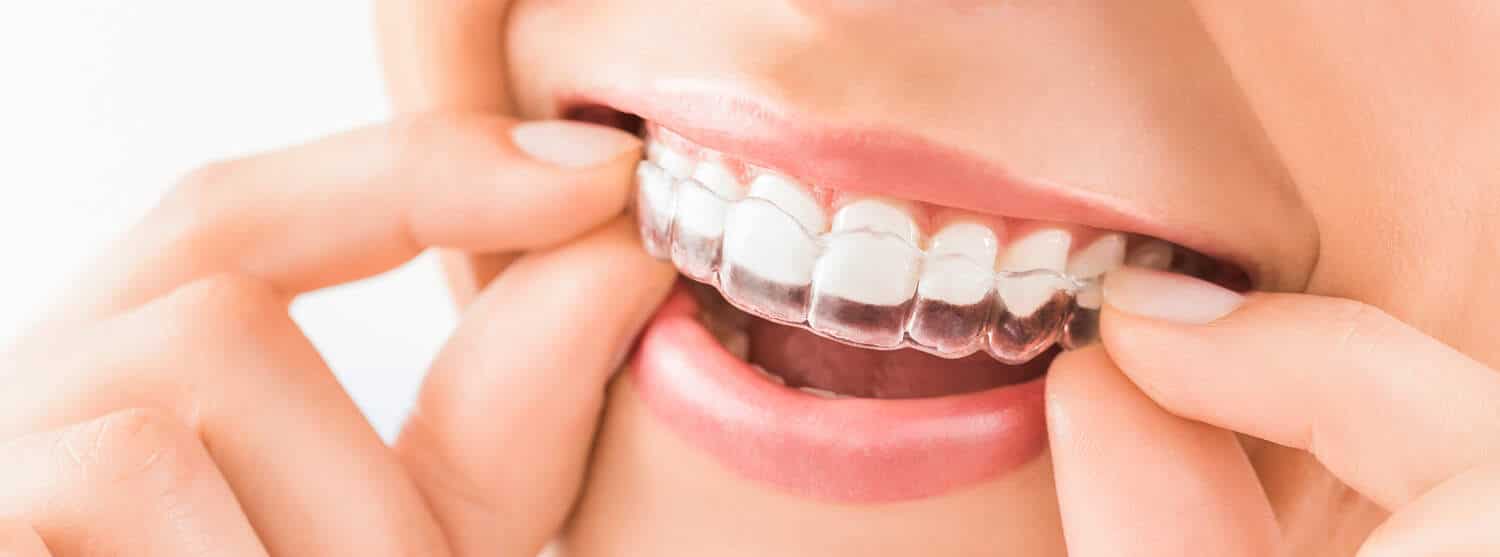 Invisalign image