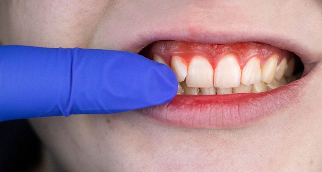 Bleeding Gums | Columbine Creek Dentistry