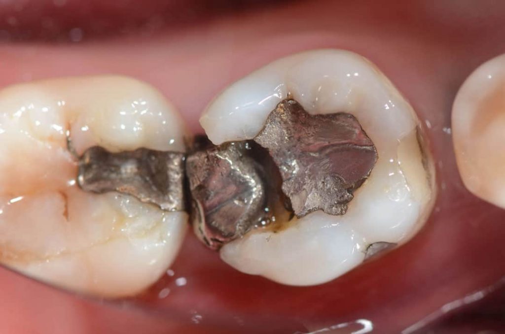 Broken Filling | Columbine Creek Dentistry