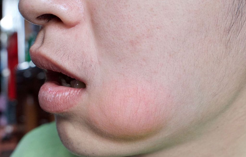 Facial Swelling | Columbine Creek Dentistry