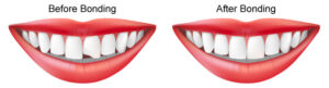 dental bonding in littleton
