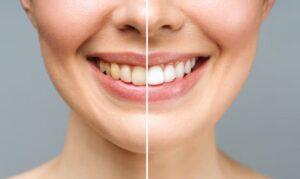 teeth whitening in columbine creek dentistry