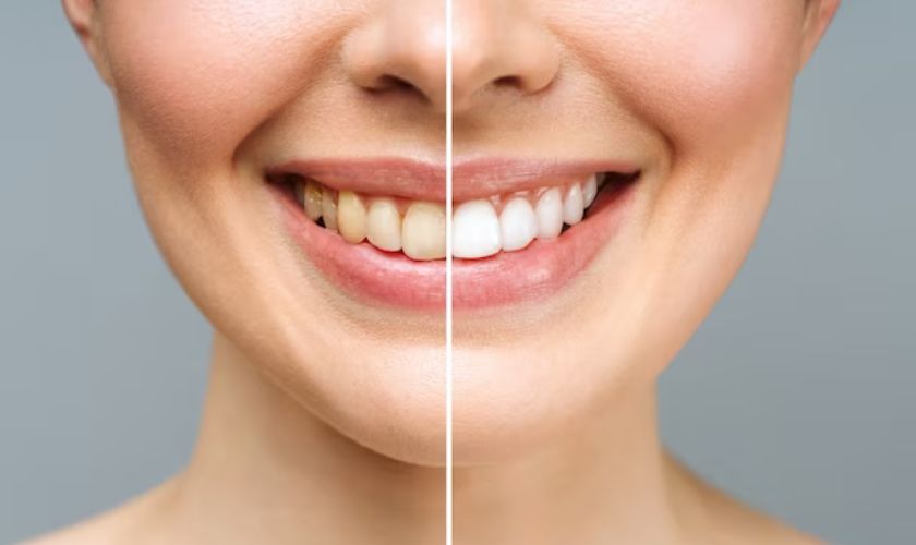 teeth whitening in columbine creek dentistry