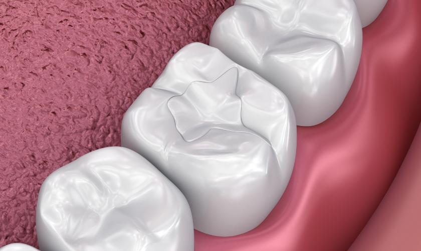 Dental Fillings in Littleton CO