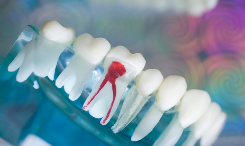 Root Canal Therapy in Littleton CO, Columbine Creek Dentistry - Dentist Littleton