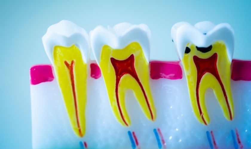 7 Common Signs You Need a Root Canal