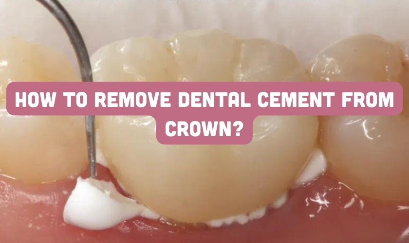 how to remove dental cement from crown