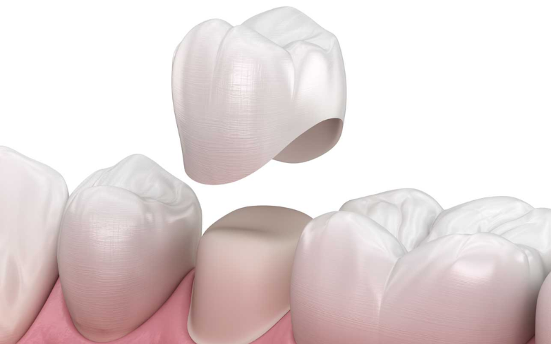 Signs You Need A Dental Crown