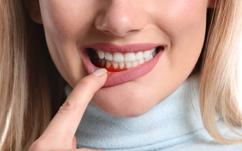 Gum Disease Treatment To Identify Swollen & Red Gum Tissue