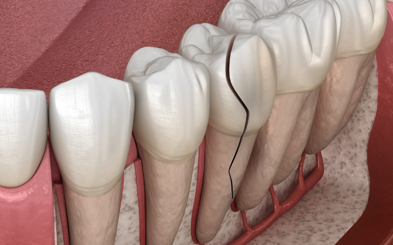 How long it takes to repair cracked tooth
