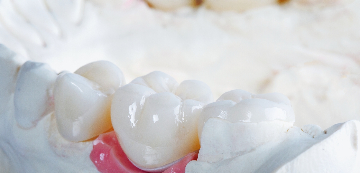 how do dental crowns affect your bite